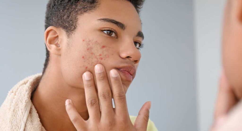 Les causes de l’acné chez l’adolescent et l’adulte